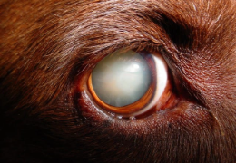 ESCLEROSIS NUCLEAR VS CATARATAS